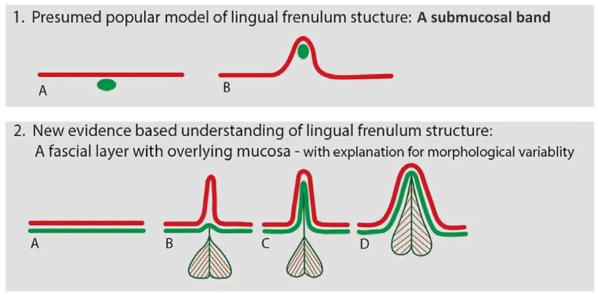 Diagram comparing the popular model of lingual frenulum structure (submucosal band) with the evidence-based model (fascial layer with overlying mucosa)