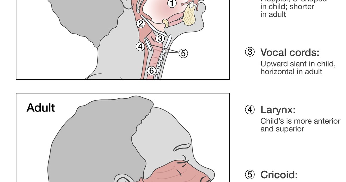 Diagram comparing adult and pediatric airway anatomy, with vocal cords, larynx, and cricoid labeled — illustrating why children are more prone to mouth breathing.