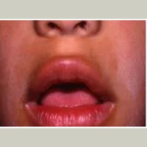 Close-up photograph of a person breathing through an open mouth — lips parted, demonstrating habitual mouth breathing posture.