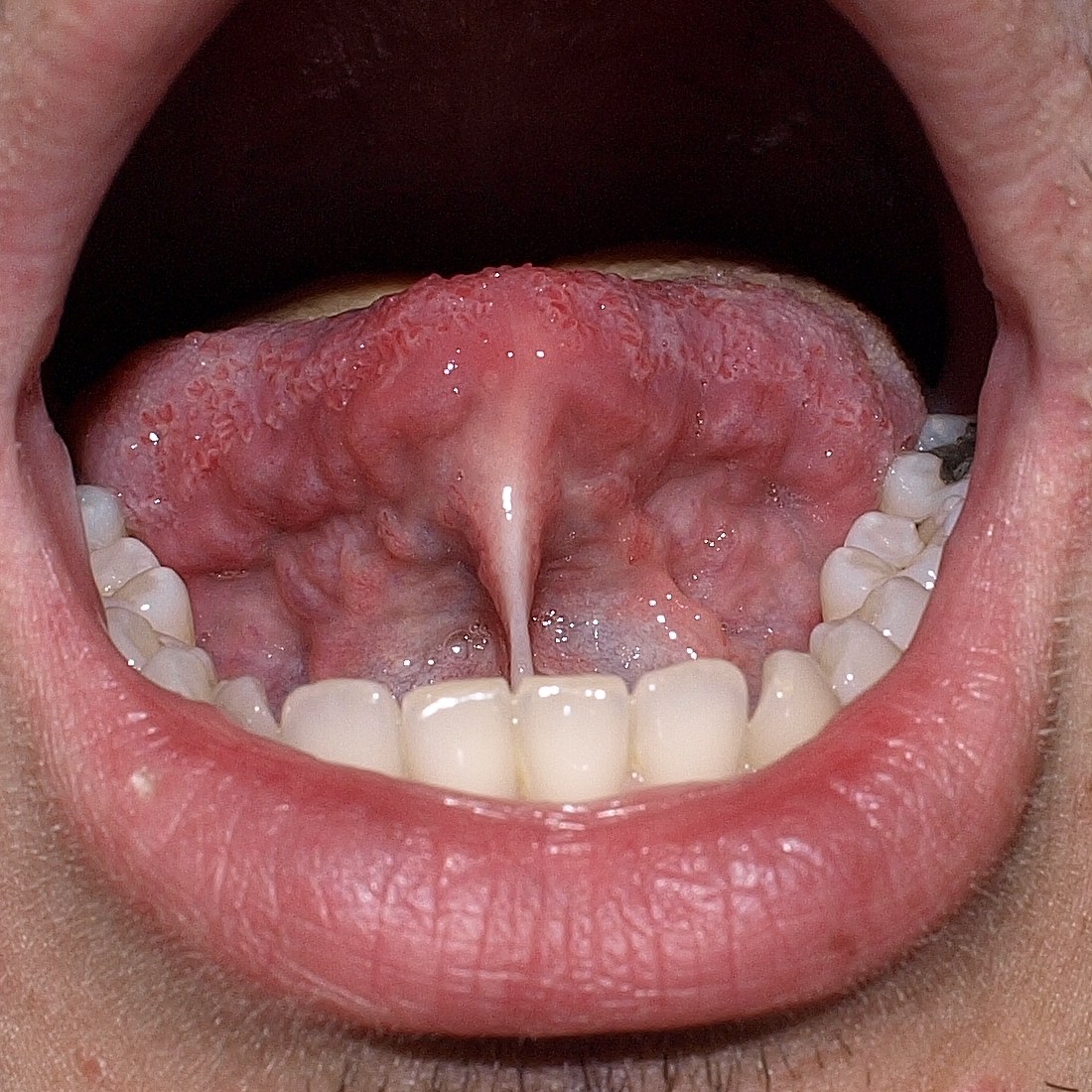 Clinical photograph of an adult with tongue-tie (ankyloglossia) showing a tight lingual frenulum pulling the tongue tip down — Klaus D. Peter, CC BY 3.0 DE